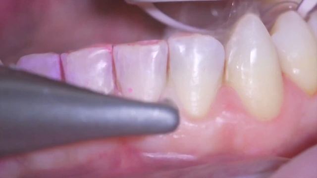 Airflow® and how to reduce aerosols смотреть онлайн