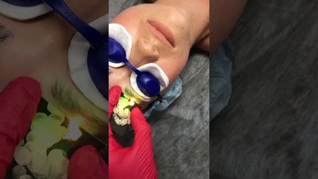 Удаление татуажа бровей неодимовым лазером, Белгород смотреть онлайн