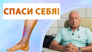 Честно о язве и лечении варикоза. Когда бить тревогу? Причины и профилактика варикоза.