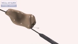 Чистка вентиляционного канала внутриканального слухового аппарата