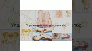 Упражнения при дисплазии
