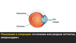 Лазерная коагуляция сетчатки глаза