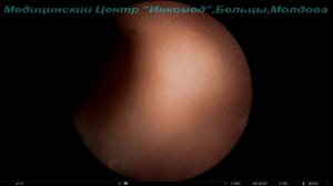 Камень левой почки , КЛТ