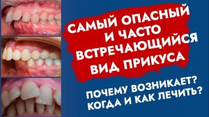 Дистальный прикус. Прогнатия. 2 класс по Э. Энглю. Неправильный прикус.