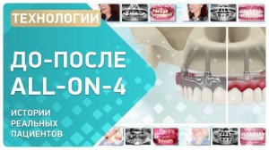 ΠΠΌΠΏΠ»Π°Π½ΡΠ°ΡΠΈΡ all on 4 ? Π΄ΠΎ ΠΈ ΠΏΠΎΡΠ»Π΅ ΠΊΠ°ΠΊ ΠΌΠ΅Π½ΡΡΡΡΡ ΠΏΠ°ΡΠΈΠ΅Π½ΡΡ