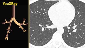 Бронхиальное дерево на КТ: долевое и сегментарное строение.