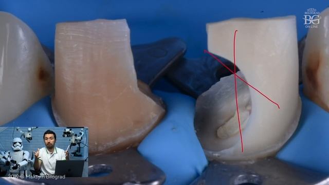 Раббердам, препарирование и эндодонтия на грани фантастики. Дентал Кейсы от BG. #04 смотреть онлайн