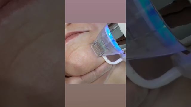 Аппарат фракционного микроигольчатого РФ лифтинга смотреть онлайн