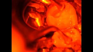 Реставрация зуба материалом ДентЛайт.avi