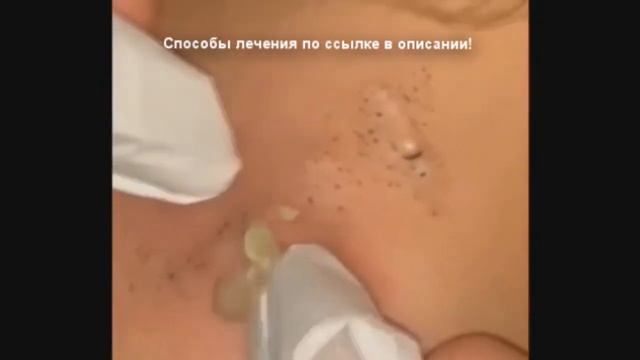 Прыщи   Огромные прыщи   Выдавливание прыщей   Релакс с акне   Черная точка