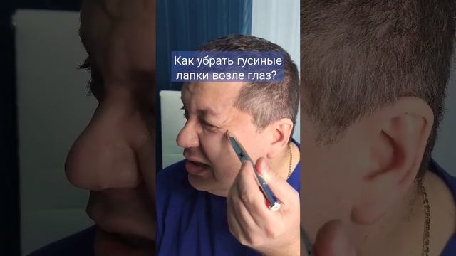 Как убрать мимические морщины возле глаз?