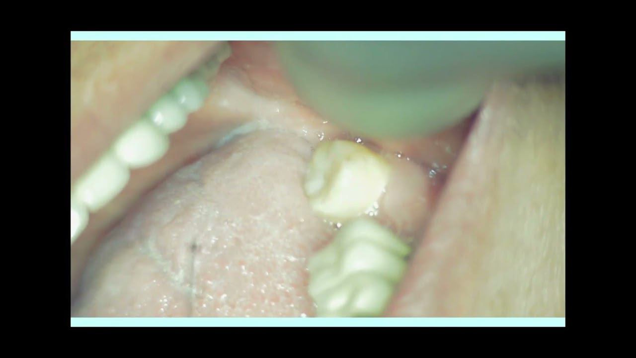 Conduction and infiltration anesthesia technique for implantation missing 37 tооth.