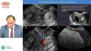 Ультразвуковая диагностика миомы матки