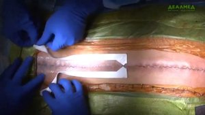 DERMABOND кожный клей высокой вязкости