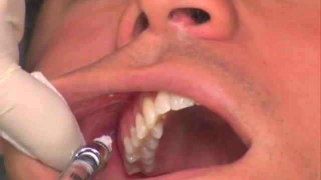 Анестезия в стоматологии Local anesthetics