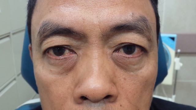 Blepharospasm смотреть онлайн