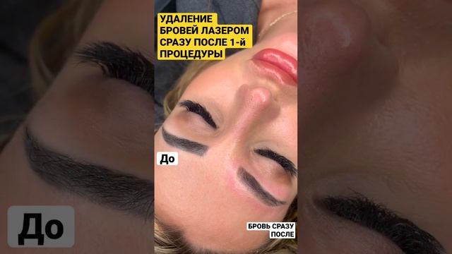 Удаление бровей при помощи мощного лазера в Ставрополе