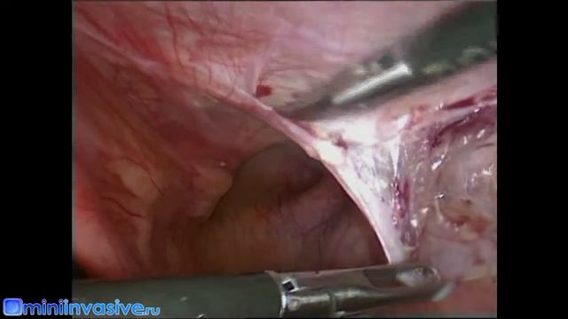 Выделение грыжевого мешка смотреть онлайн
