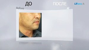 Смас лифтинг на аппарате Лифтера 2