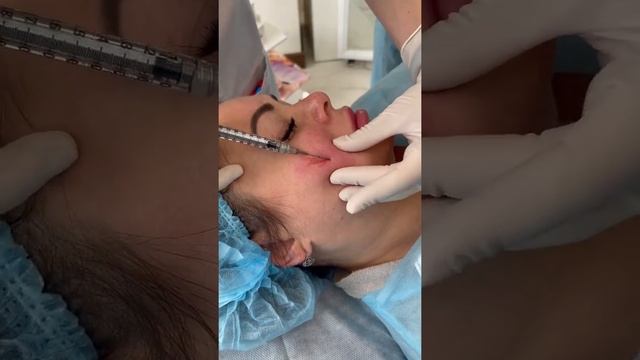 Trueself Poly-L-Lactic Acid (PLLA) filler 400 face injection for nonsurgical face rejuvenation