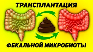 Пересадка фекальной микробиоты