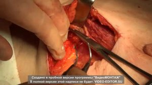 Видео подкожная мастэктомия по Маддену с установкой экспандера
