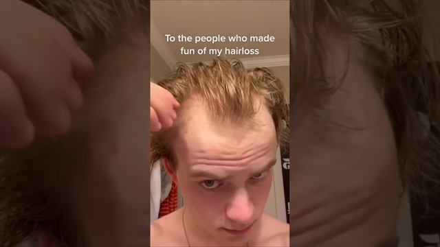 To the people who made fun of my hairloss