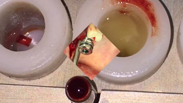 Использование A-PRF при закрытом синус-лифтинге смотреть онлайн