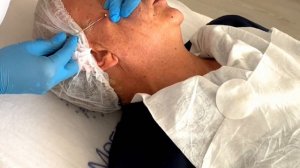 Нитевой лифтинг нитями Cog