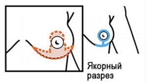 Подтяжка груди. Виды подтяжек. Колбасин Д.В.