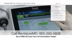 Fotona 4D Laser Face Lift in #Knoxville, TN | Non-Invasive Facelift, Revitalyze MD: (865) 293-5828