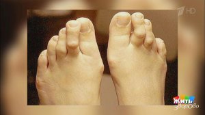 Молоткообразный палец. Жить здорово! Фрагмент выпуска от 12.03.2019