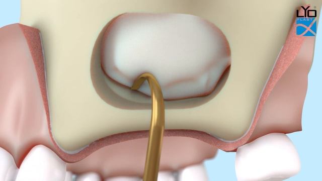 Поднятие дна синуса с пластикой в области двух-трех зубов на высоту от 9мм. Латеральный доступ смотреть онлайн