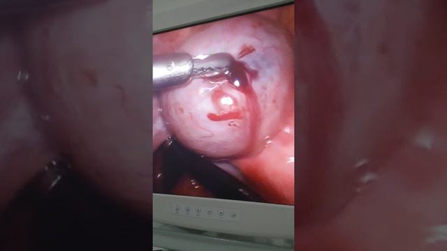 Апоплексия кисты яичника..кровотечение в брюшную полость.