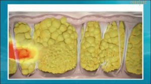 Что такое  Cellulaze_ Аппарат от целлюлита