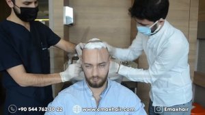 пересадка волос и отзывы одного из наших пациентов артимии из россии #Eamx #волос #турция #россия