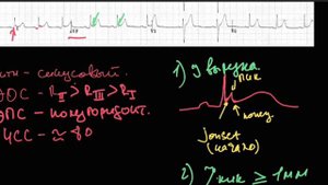 Синдром преждевременной реполяризации желудочков. Отличия от перикадита.