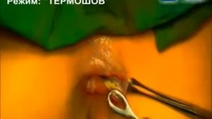 Геморроидэктомия с использованием технологии "ТЕРМОШОВ" 1