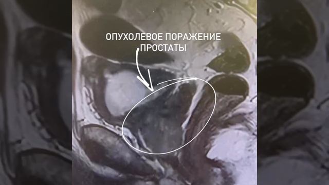 Опухолевое поражение простаты. Рак предстательной железы. Рак простаты