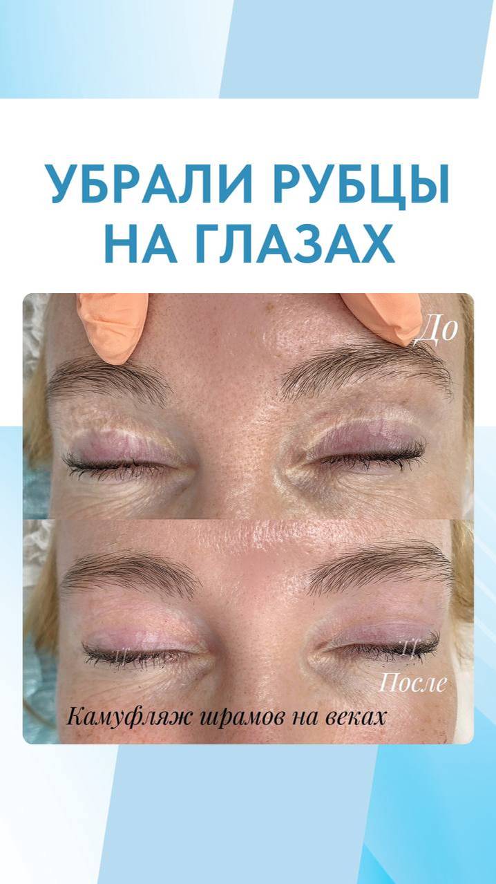 ШРАМЫ НА ВЕКАХ ПОСЛЕ БЛЕФАРОПЛАСТИКИ | УЖЕ ВТОРАЯ ПРОЦЕДУРА