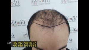 Soch ko'chirib o'tkazish bo'yicha Fadil klinikasi 2021. Buxoro shahri.