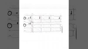 Как быстро определить ритм на ЭКГ? Предсердный ритм.#Shorts