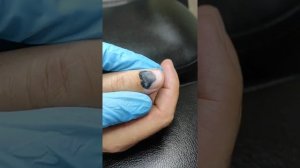 Очень интересная нарезка из практики. До и После. #podologia #помощь #здоровье #подолог #выезднадом