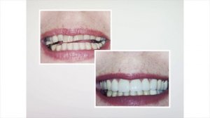 Brentwood Center for Cosmetic Dentistry : Tooth Whitening in Santa Monica, CA