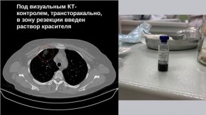 Case 3. ВТС атипичная резекция верхней доли правого легкого при аденокарциноме insitu.