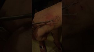 Как снять швы в домашних условиях)