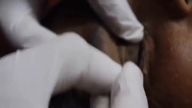 Removes acne, Давим прыщи, чёрные точки. Залипательно 2021 смотреть онлайн