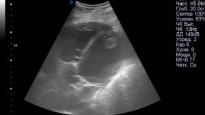 Верхушечный подвижный тромб левого желудочка