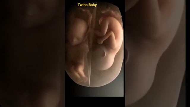 twins baby fighting in mother womb।। twins baby in amniotic sac ।। #pragnancy #doctor #mbbs #short