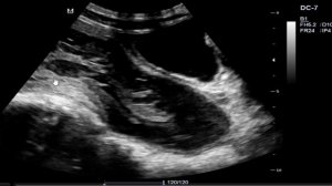 Hermaphrodite( Both male and female genitalia ) on ultrasound scan.
